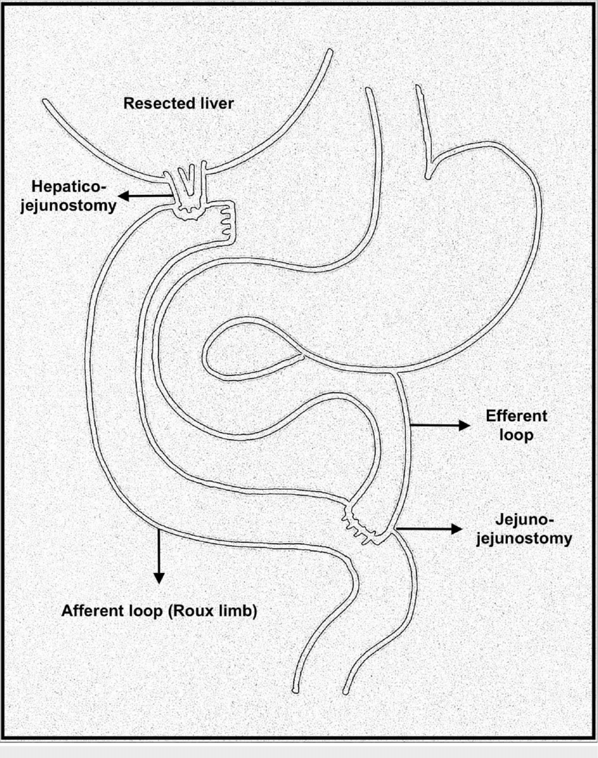 Roux-en-Y Hepaticojejunostomy – ahmedabadliversurgeons.com